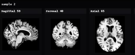 AnaDiffusion sample 2 in sagittal, coronal, and axial views