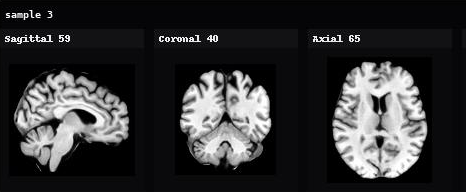 AnaDiffusion sample 3 in sagittal, coronal, and axial views