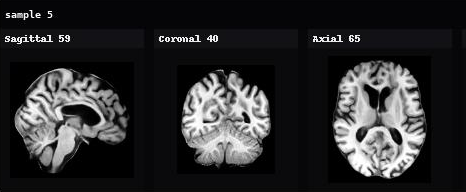 AnaDiffusion sample 5 in sagittal, coronal, and axial views