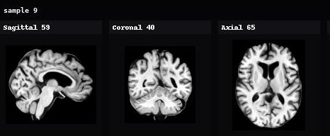 AnaDiffusion sample 9 in sagittal, coronal, and axial views